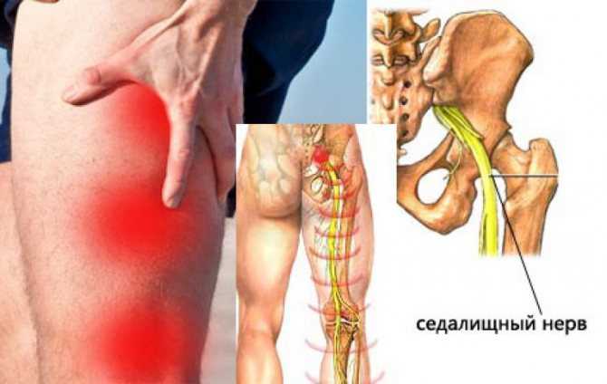 Диагностика защемления нерва в коленном суставе